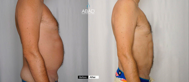 Lipo masculina + Marcación abdominal